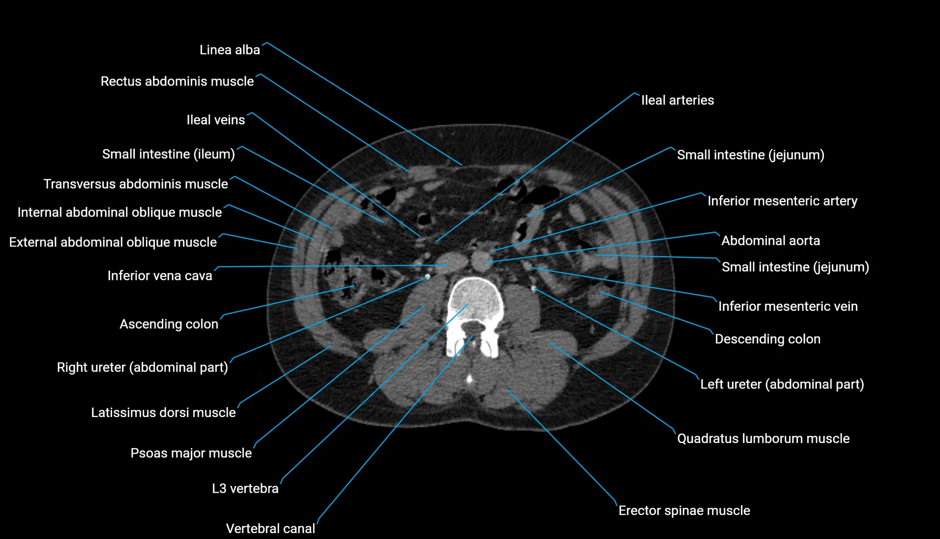 CT urogram axial cross sectional anatomy  labelled radiology image-00130.webp